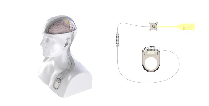 China's First Subdural Brain Implant Enters Trial — No Piercing, No Heating